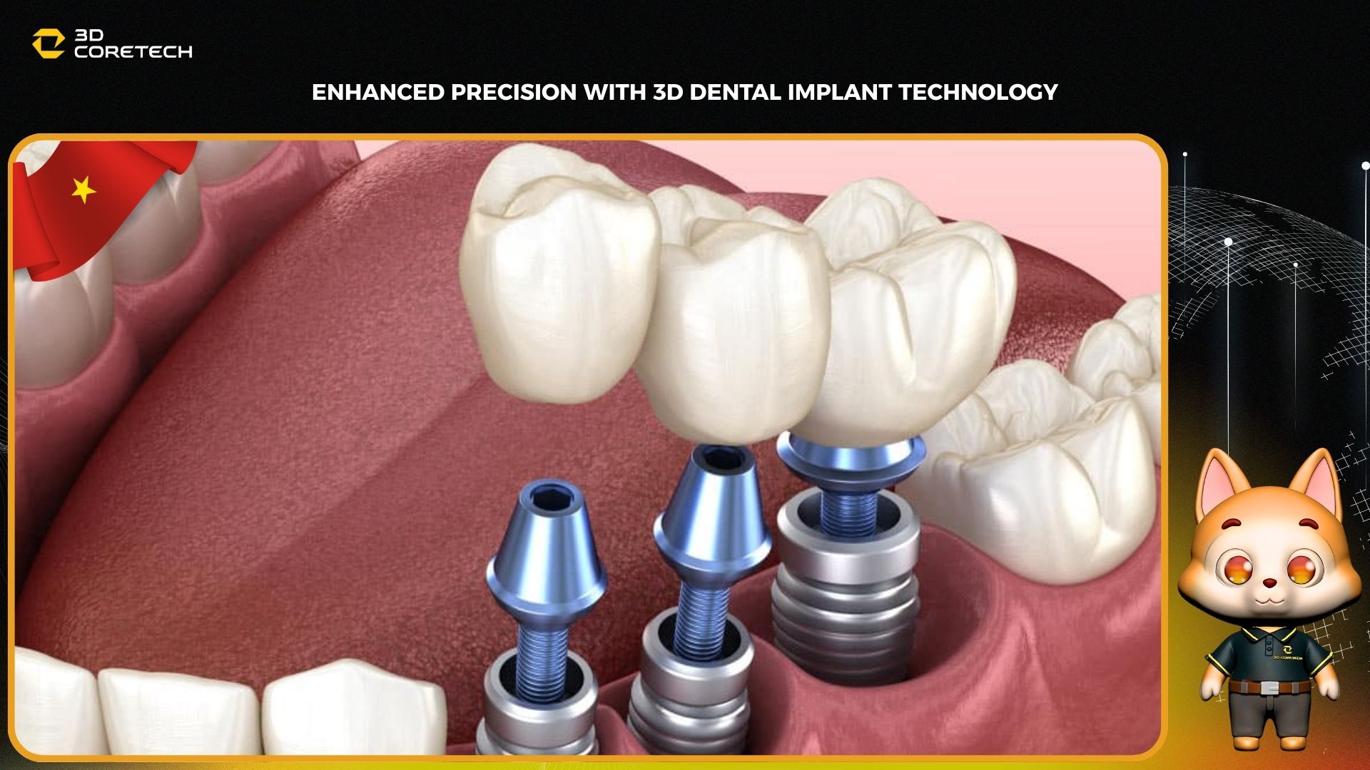 Nâng cao độ chính xác với công nghệ cấy ghép nha khoa 3D